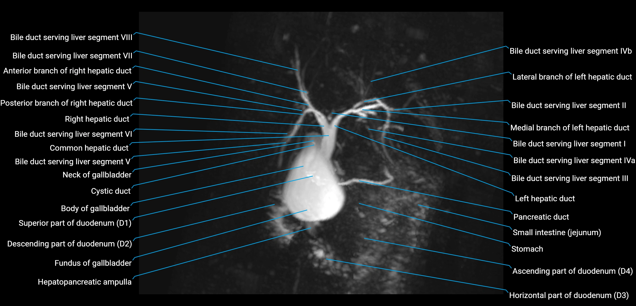 MRCP MIP MRI  anatomy labelled image-img-01003-00017.webp